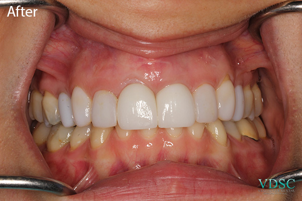 Close-up of a patient's front teeth before and after receiving implants at Vancouver Dental Specialty Clinic.