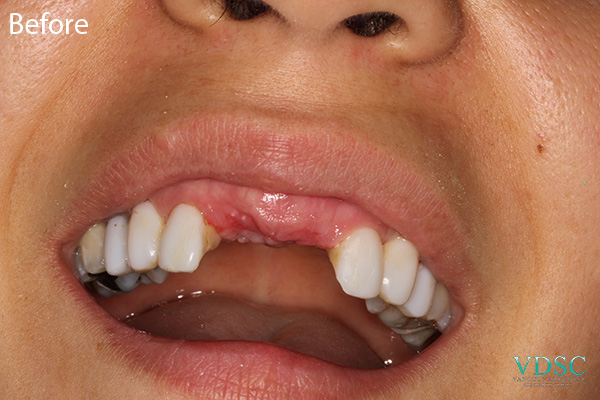 Before and after comparison of front teeth implants for missing teeth at Vancouver Dental Specialty Clinic.