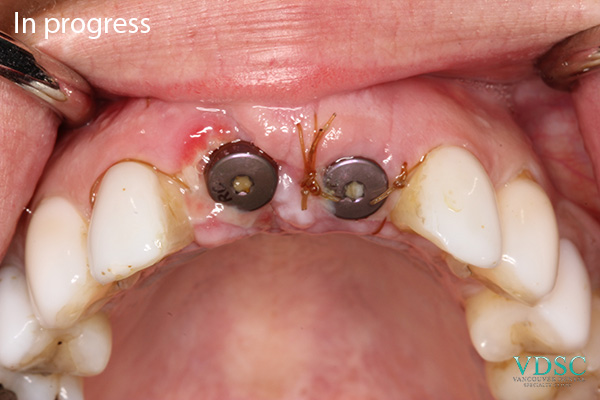 Side-by-side comparison of a patient's smile before and after receiving front teeth implants at Vancouver Dental Specialty Clinic.