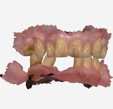 What Are Digital Dentures and How They Work?