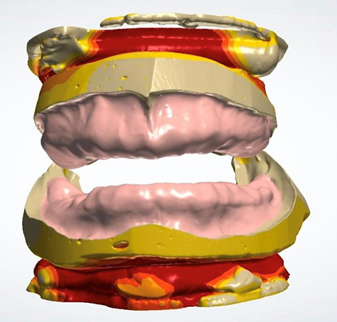 What Are Digital Dentures and How They Work?