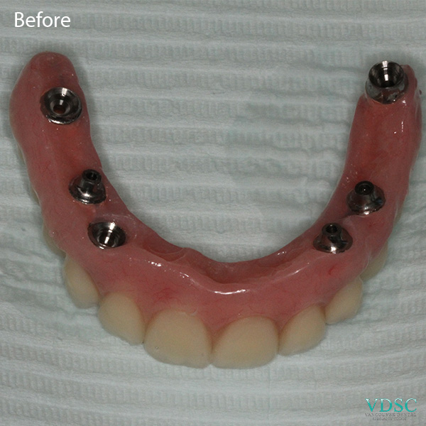 Before and after comparison of a fixed implant denture at Vancouver Dental Specialty Clinic