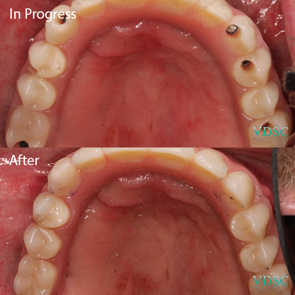 Side-by-side comparison of a patient's smile before and after receiving a fixed implant denture at Vancouver Dental Specialty Clinic.
