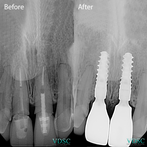 "X-ray of a dental implant: Illustrating a successful implant placement with surrounding bone support