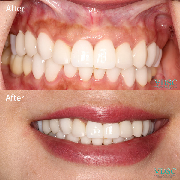 Before and after immediate upper front dental implant vancouver