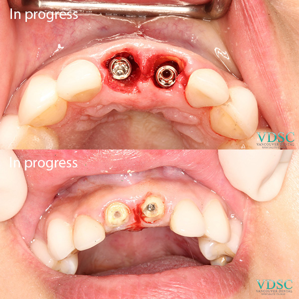 Immediate upper front dental implant procedure: Before and after images showing a successful implant in the upper front teeth area