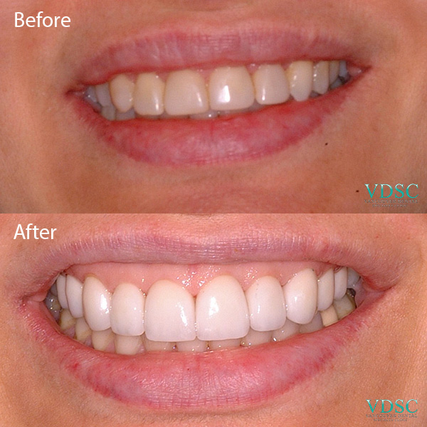 Before and after upper front teeth veneers by Vancouver Dental Specialty Clinic