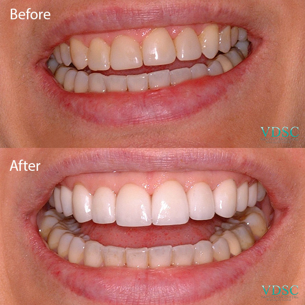 Before and after upper front teeth makeover by Vancouver Dental Specialty Clinic