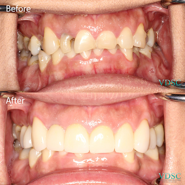 Before and after of a smile make over with ceramic veneers at Vancouver Dental Specialty Clinic.