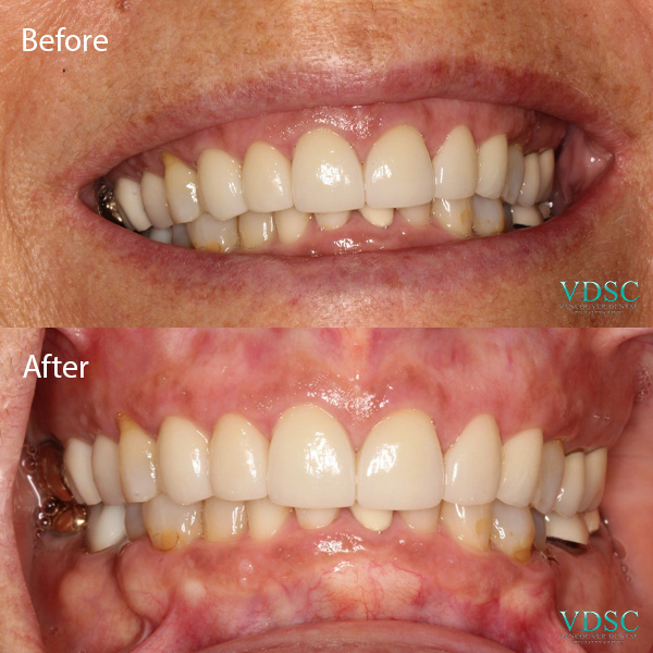 Before and after upper front teeth restoration by Vancouver Dental Specialty Clinic