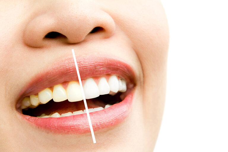 Dental Acid Erosion Causes, Symptoms, Prevention VDSC