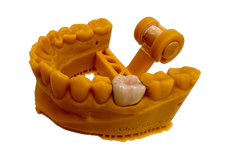 Signs Your Dental Crown Needs to Be Replaced VDSC