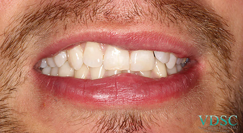 Image of the same tooth repaired following a dental emergency