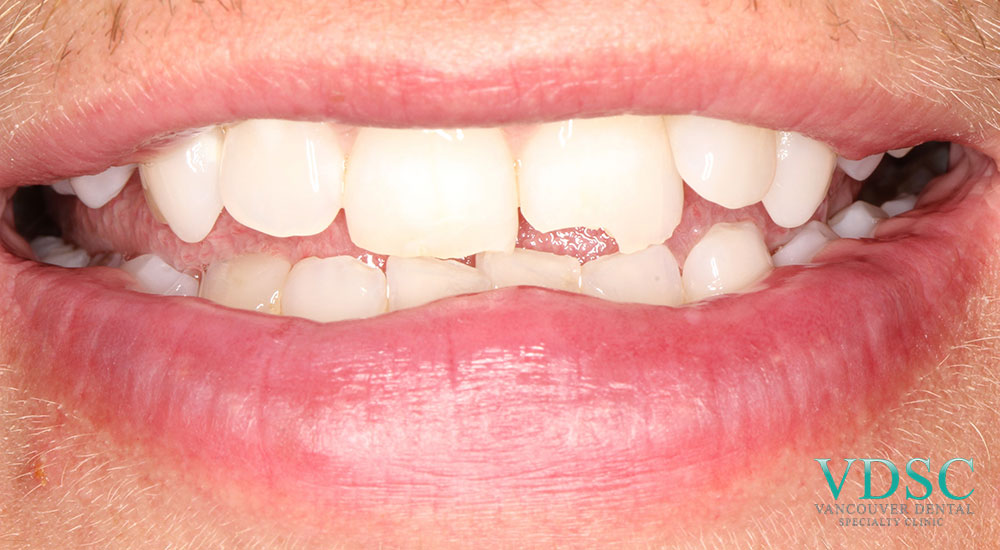 Image of a chipped tooth before treatment