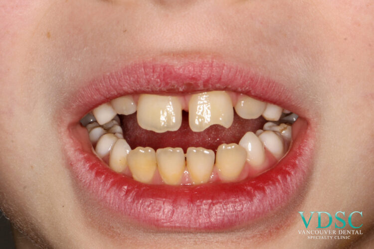 Close-up of chipped tooth injury in athlete before treatment at Vancouver dental emergency clinic