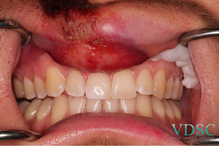 Dental trauma due to scooter accident: fracture of the upper right central incisor after